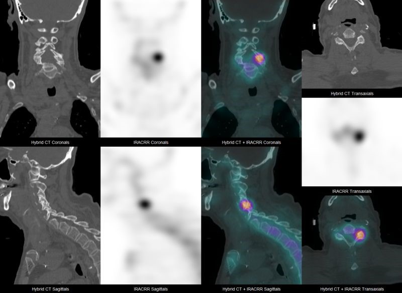 NEW NM/CT 860 SPECT camera now ready for Patients!